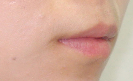 부정교합. 지금 입을 가만히 다물어보세요~~ 관련 이미지 4