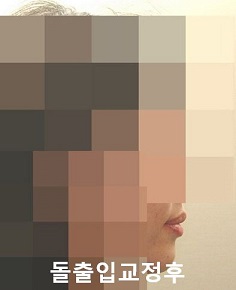 돌출입교정에 성공하는 방법 3가지! 관련 이미지 7