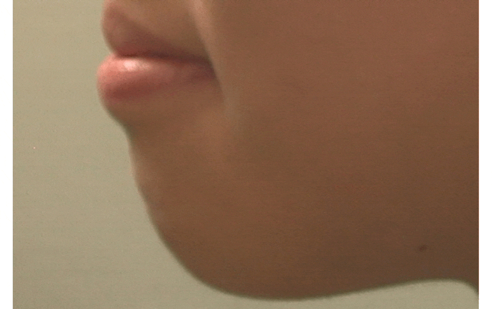 [돌출입교정후기] 돌출입교정전후 깜짝개선!! 그러나 모든 경우에서 이렇게 변하는 것은 아닙니다~~!! 관련 이미지 3