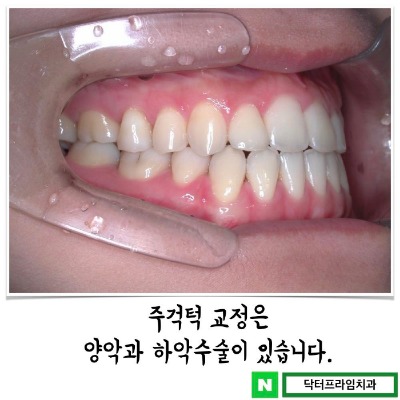 주걱턱교정 치료 보통은 양악수술 보다 하악을 먼저 생각 하지만… 관련 이미지 2