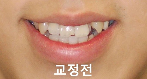 덧니교정과정, 4가지 요점만 알고 시작하세요! 관련 이미지 21