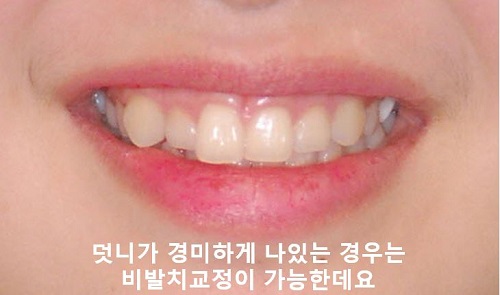 덧니교정과정, 4가지 요점만 알고 시작하세요! 관련 이미지 7