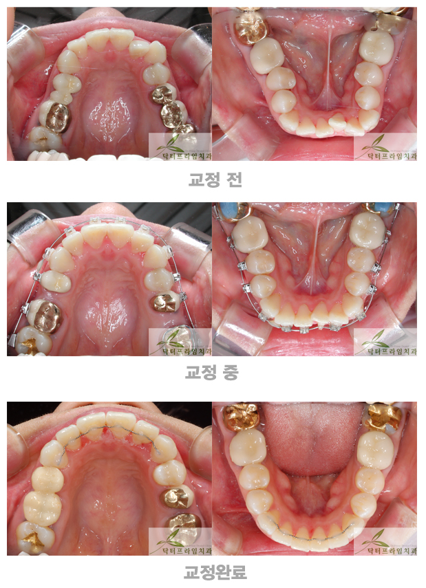 [치아교정후기] 치아배열이 고르지않고, 보철물이 많은 경우의 치아교정후기 관련 이미지 1