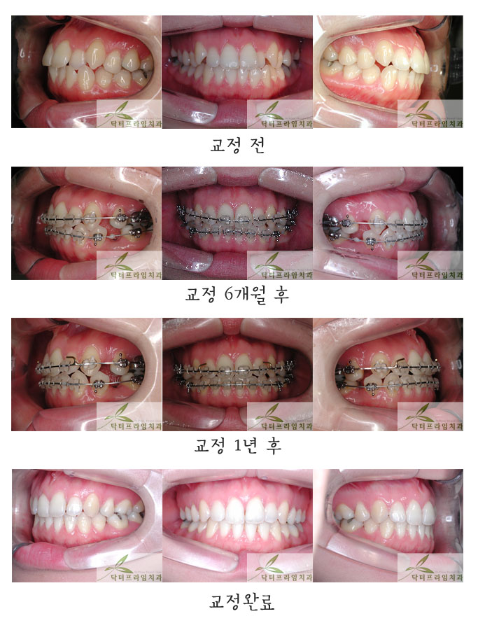 [치아교정후기] 덧니교정, 4개발치, 교정기간 2년, 세라믹교정기 관련 이미지 1