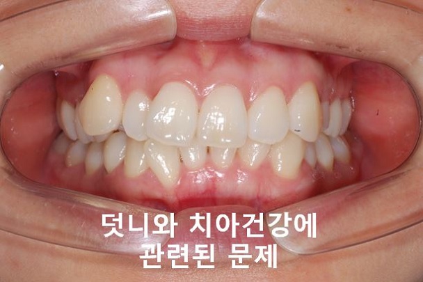 청소년, 덧니교정 안하면 이렇게 된다! 관련 이미지 5