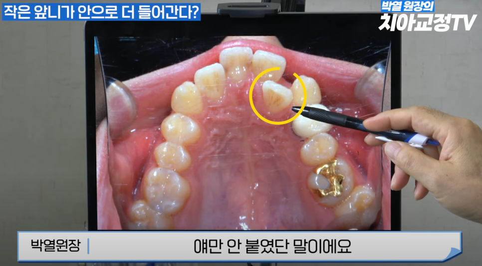 강남역 교정치과 :: 앞니 교정 시작 전에 꼭 알아야 할 한 가지 사실! 관련 이미지 7