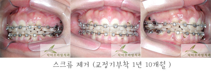 [치아교정후기] 30대 돌출입교정전후와 후기 관련 이미지 4