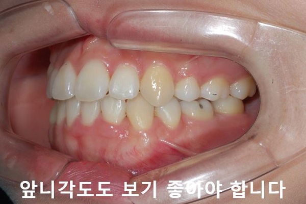 덧니교정 조심할것 3가지 관련 이미지 11