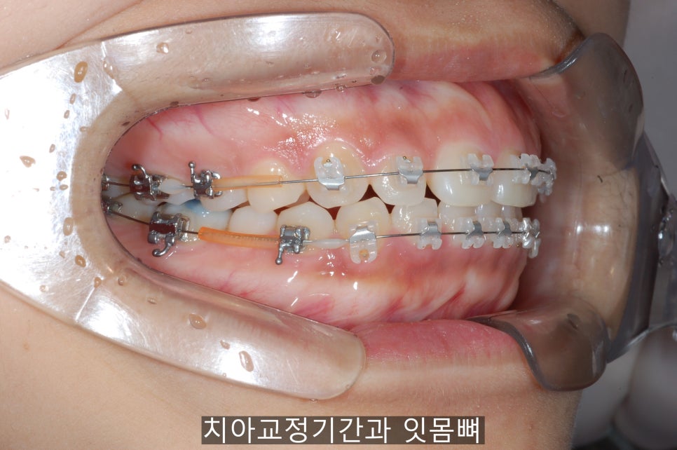치아교정기간 짧아지는 방법 6가지! 관련 이미지 4