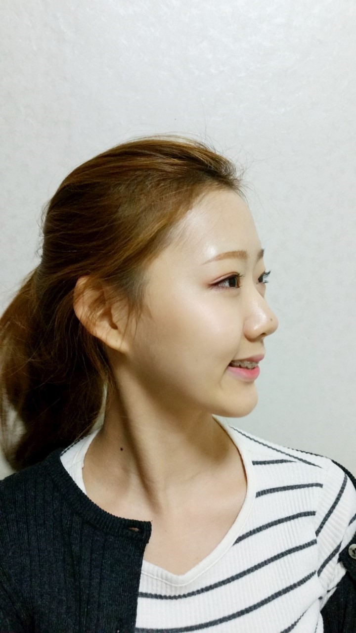 [치아교정후기] 앞니돌출교정후기(15) 관련 이미지 2