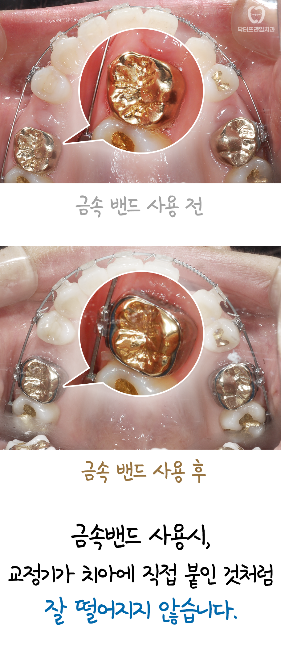지르코니아, 골드크라운, 브릿지가 있어도 교정 가능한가요? &ndash; 주의할 점과 교정 후 관리까지 관련 이미지 5