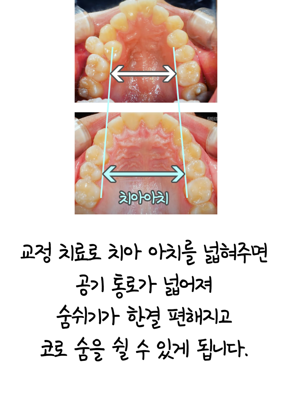 The Habit of Breathing Through the Mouth Damages the Face and Teeth (It Can Be Changed with Orthodontics) image 4