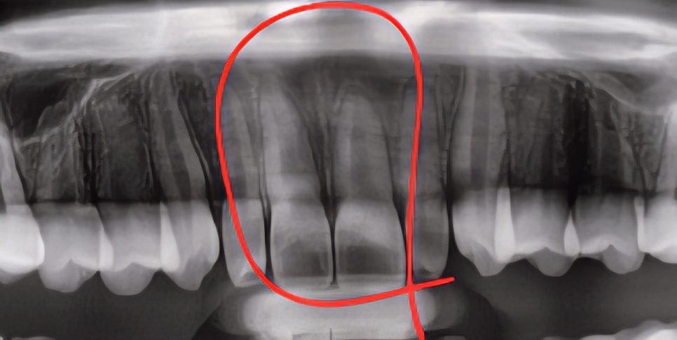 What Is Root Resorption? Changes in the Front Tooth Roots That Can Occur During Orthodontic Treatment image 5