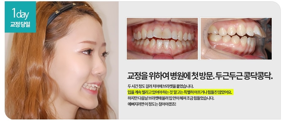 [돌출입교정전후] 앞니돌출교정사례 관련 이미지 1