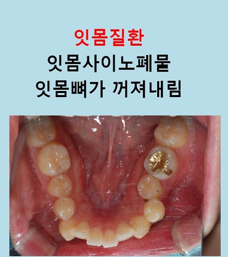 교정만으로 개선가능한 안면비대칭 알아보기(닥터프라임치과) 관련 이미지 8