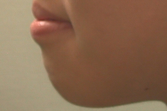 [돌출입교정후기] 돌출입교정전후 깜짝개선!! 그러나 모든 경우에서 이렇게 변하는 것은 아닙니다~~!! 관련 이미지 1
