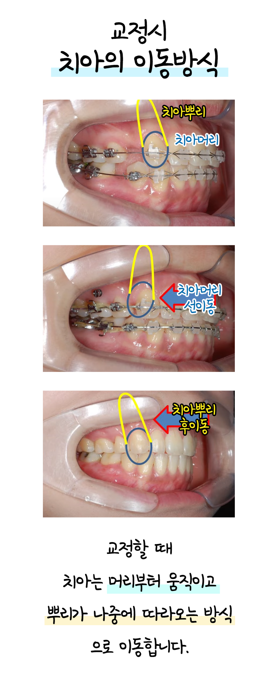 왜 치아교정은 쉽지 않을까? 치아이동&middot;불편함&middot;턱관절까지 한눈에 이해하기 관련 이미지 1