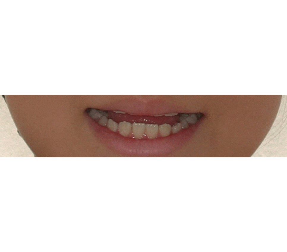 [치아교정후기] 우리아이 웃을때 위앞니가 안보여요 ㅠ 관련 이미지 3