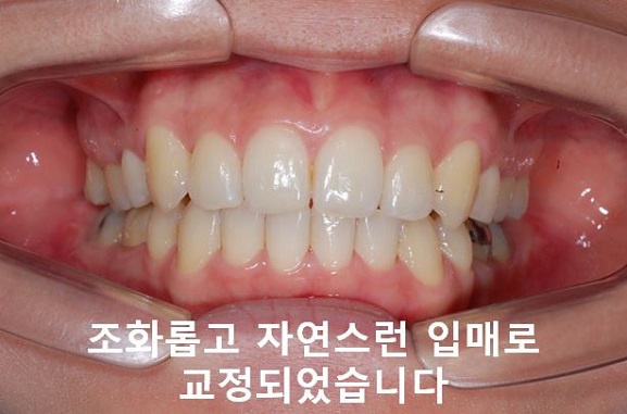 덧니교정이 곧 입매교정! 관련 이미지 10