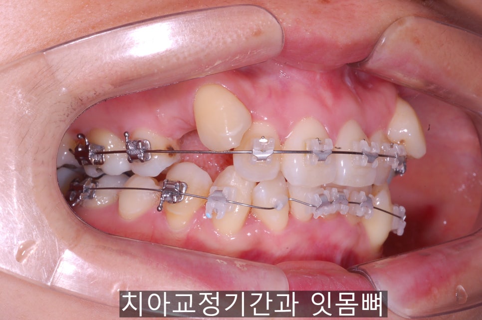 치아교정기간 짧아지는 방법 6가지! 관련 이미지 5