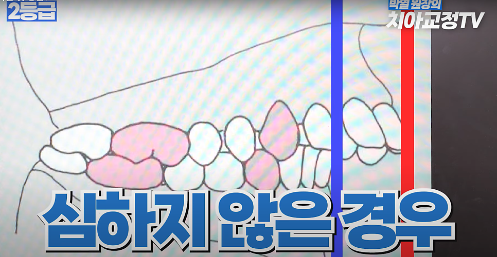 예뻐지는 교정 ? 미용 교정 후 예뻐지는 조건 & 등급 총정리! 관련 이미지 7