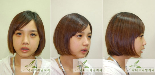 [주걱턱교정] 주걱턱 양악선수술사례. 20대여성 관련 이미지 1