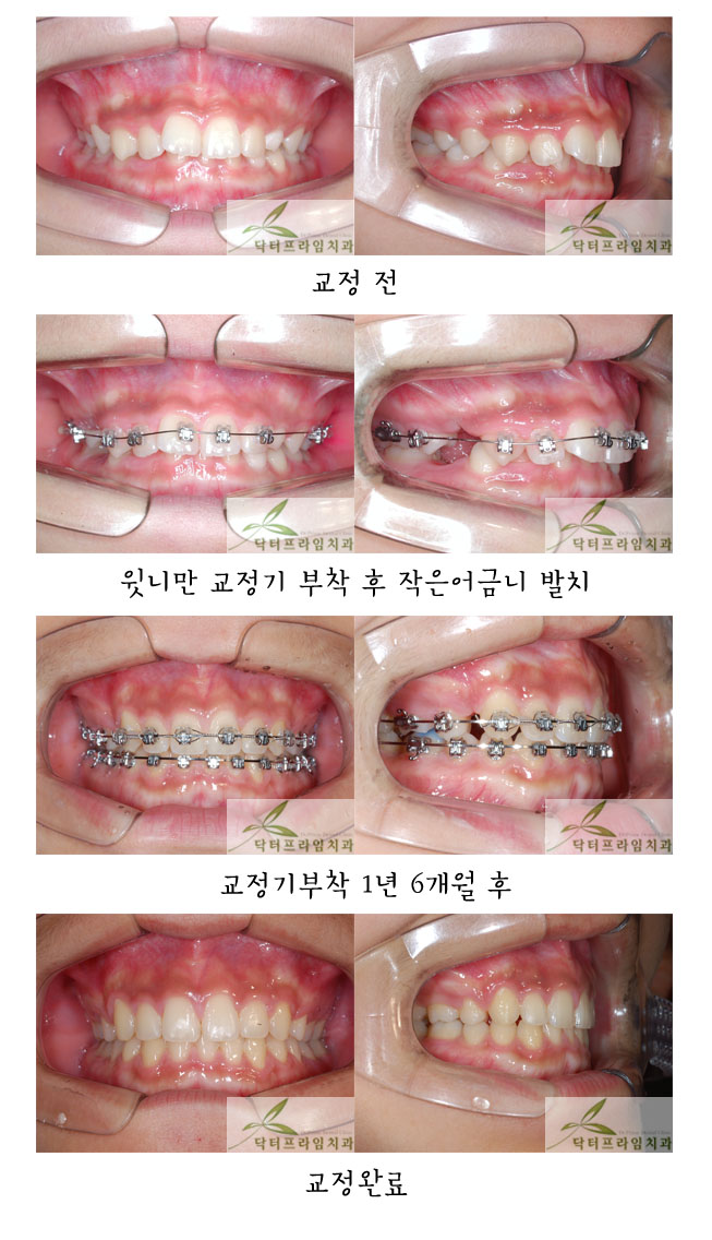 [치아교정후기] 우리아이 윗니가 아랫니를 너무 많이 덮어요! 과개교합은 특히 조기에 교정이 필요합니다~! 관련 이미지 1