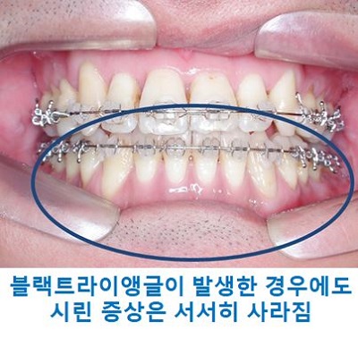 교정시작을 망설이게 하는 치아교정통증(1) 관련 이미지 16