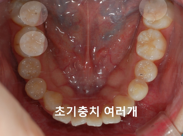 교정시작하려는데 충치치료를 먼저 해야하나요? 관련 이미지 3