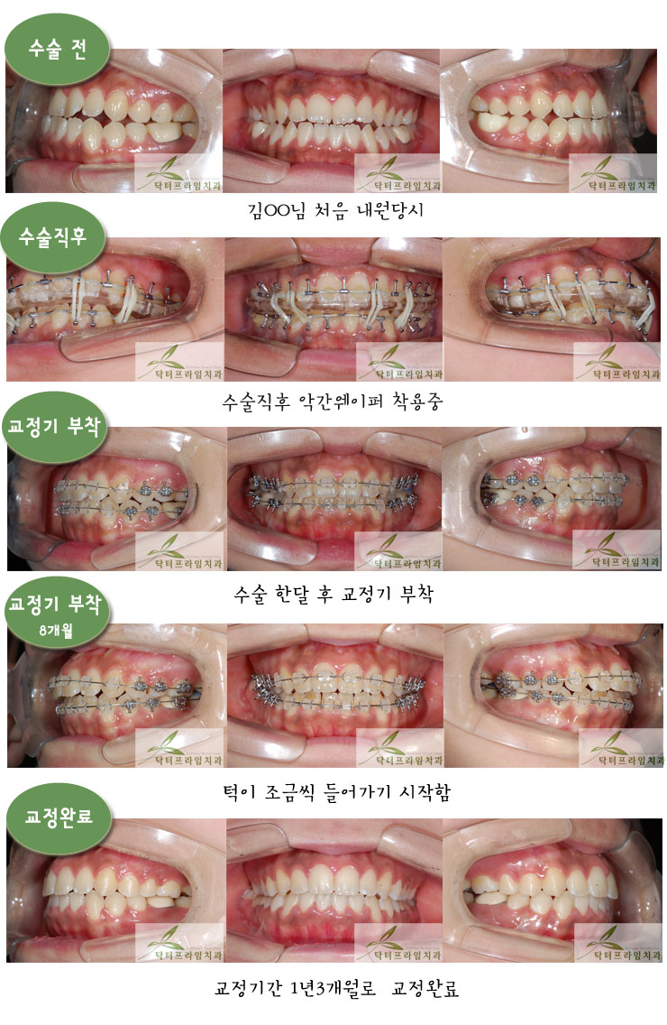 [치아교정후기] 아래턱과성장과 부정교합으로 양악수술후기 관련 이미지 1