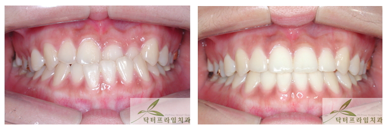 [치아교정후기] 반대교합교정전후: 수술없이 교정만으로 가능한 경우도 많아요. 그러나 턱이 많이 길고 턱길이를 줄이고자 한다면 수술해야... 관련 이미지 1
