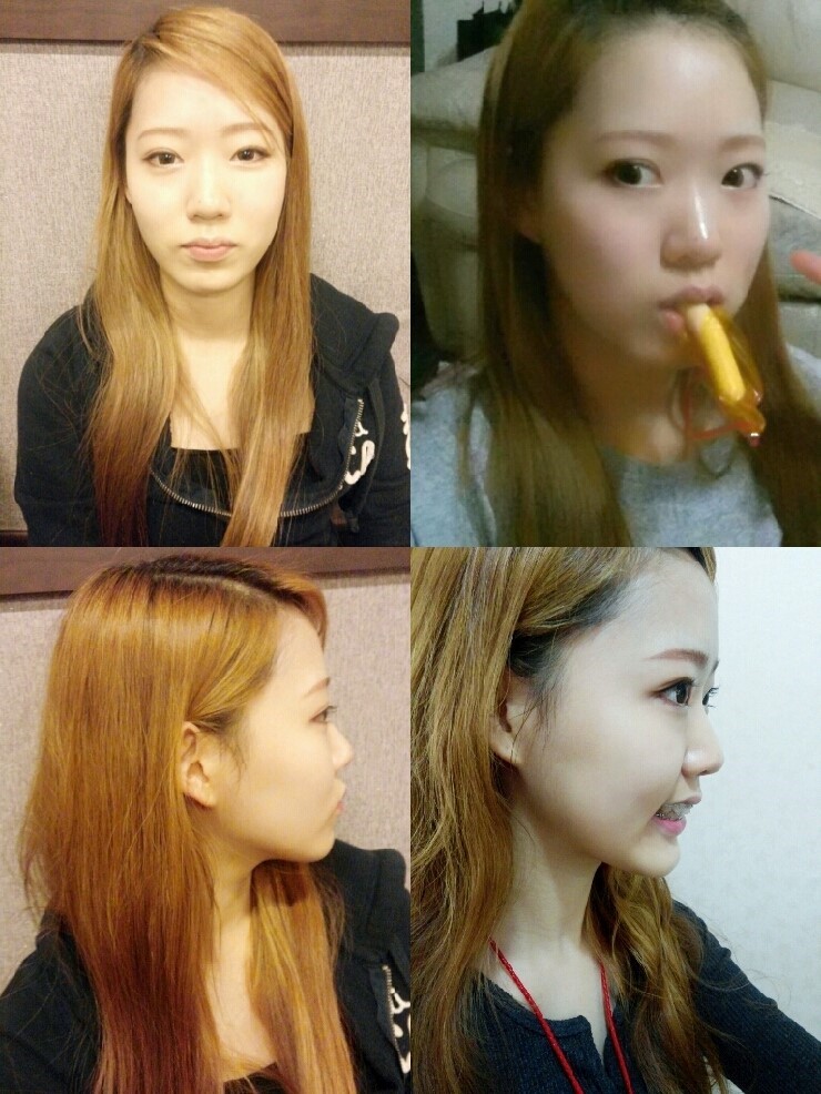 [치아교정후기] 앞니돌출교정후기(6) 관련 이미지 1