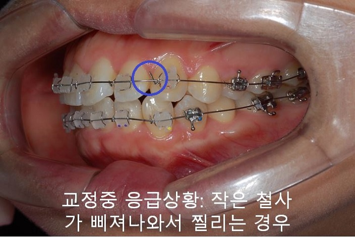교정치과 잘 고르는 법! 먼 치과, 근처치과!! 관련 이미지 8