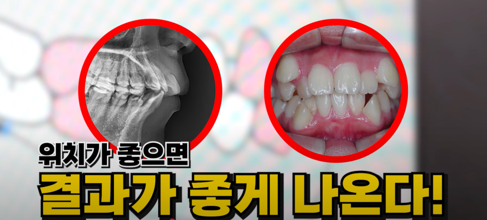 예뻐지는 교정 ? 미용 교정 후 예뻐지는 조건 & 등급 총정리! 관련 이미지 8