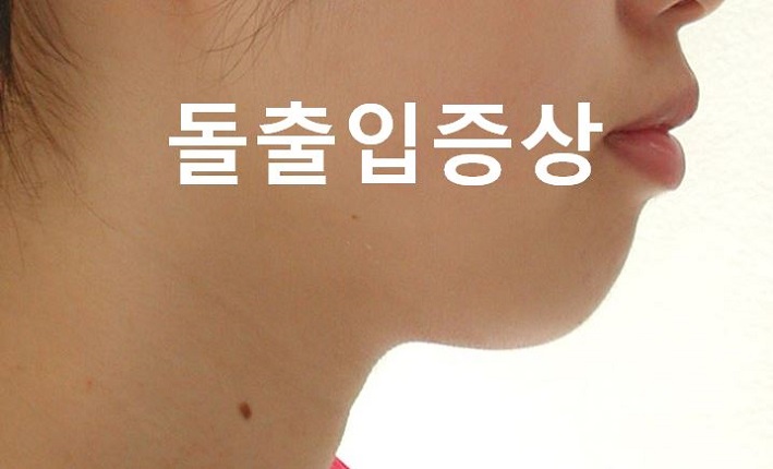돌출입교정의 효과적인 시기! 관련 이미지 2