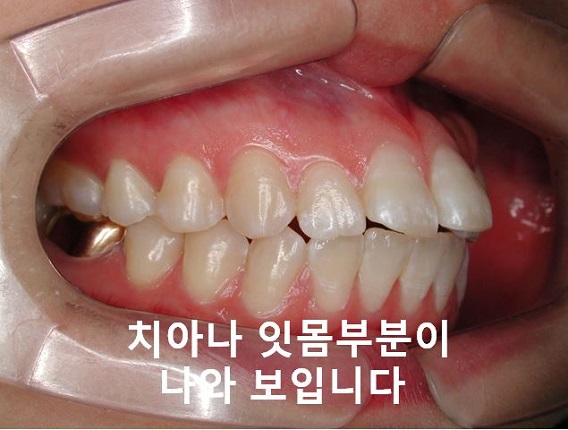 돌출입교정의 효과적인 시기! 관련 이미지 3