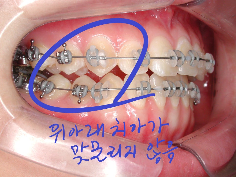 [치아교정] 양악수술과 치아교정의 은밀한 관계.주걱턱. 안면비대칭 환자들 치아교정 반드시 해야하나? 관련 이미지 2
