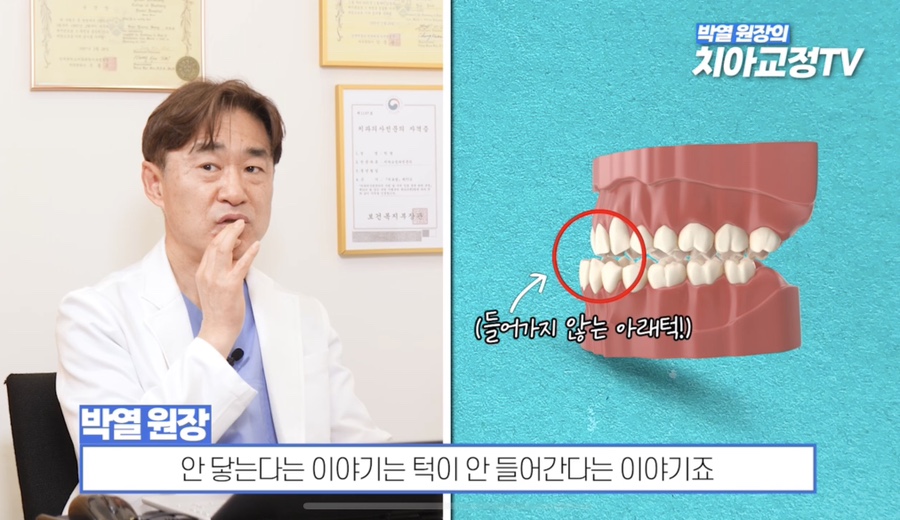 Can Adult Crossbite Be Treated With Orthodontic Dental Care? image 30