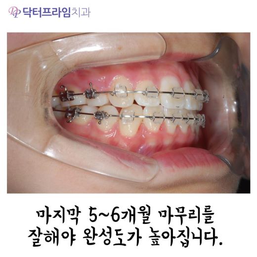 잇몸돌출교정 방법, 사진으로 보는 교정 방법! 관련 이미지 6