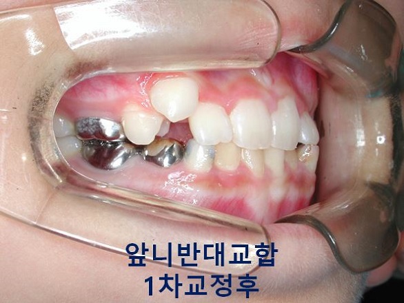 초등학생 앞니반대교합의 교정시기 안놓치는 법! 관련 이미지 7