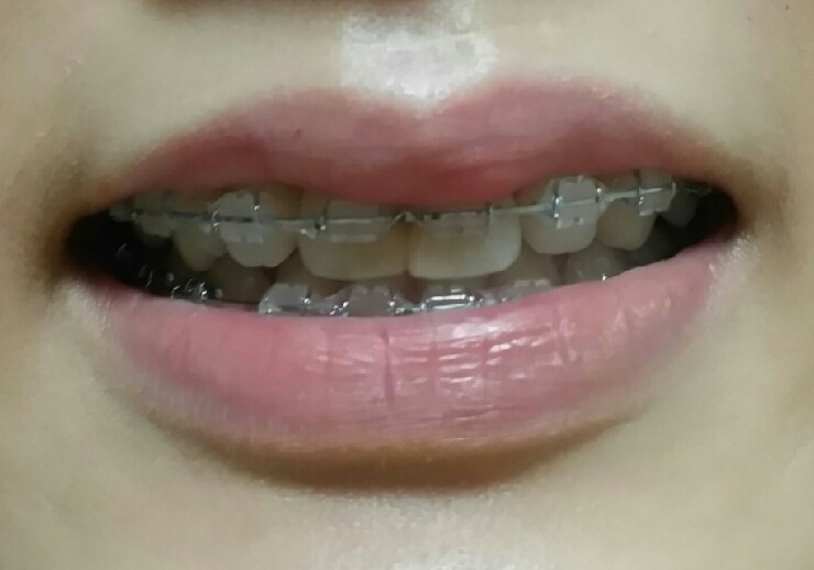 [치아교정후기] 앞니돌출교정후기(16) 관련 이미지 1