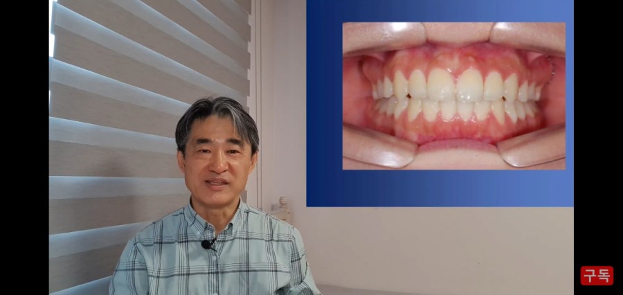 1년치아교정으로 예쁜미소 만드는 법! 관련 이미지 11