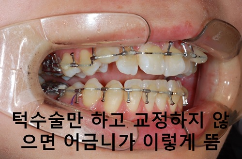 덧니와 주걱턱이 같이 있는 경우에 가장 효과적인 교정방법! 관련 이미지 18
