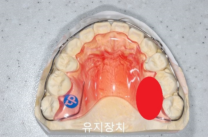 치아교정) 유지장치는 평생 해야 한다? 관련 이미지 5