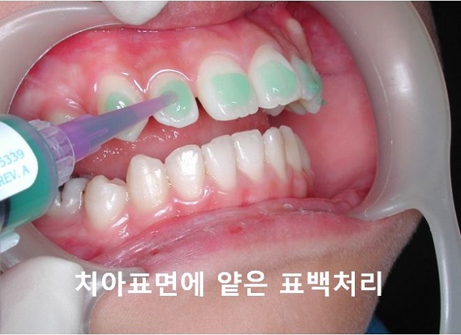 [교정기부착] 돌출입교정할때 교정기부착하는 법! 관련 이미지 4