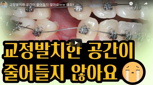 교정발치한 공간이 줄어들지 않아요ㅠㅠ, 왜죠? 관련 이미지 22
