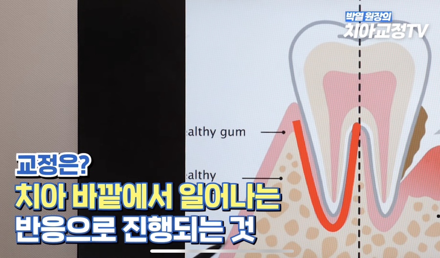 강남역치아교정, 신경치료 받은 치아도 교정이 될까? 관련 이미지 11