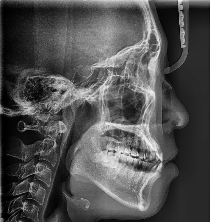 Can Braces Make the Lower Jaw Recede? When It’s Possible vs. When Surgery Is Needed image 4