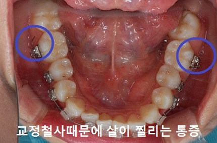 교정시작을 망설이게 하는 치아교정통증(2) 관련 이미지 3