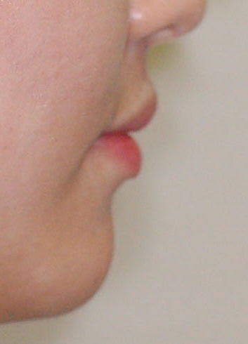 치아교정얼굴변화 관련 이미지 11
